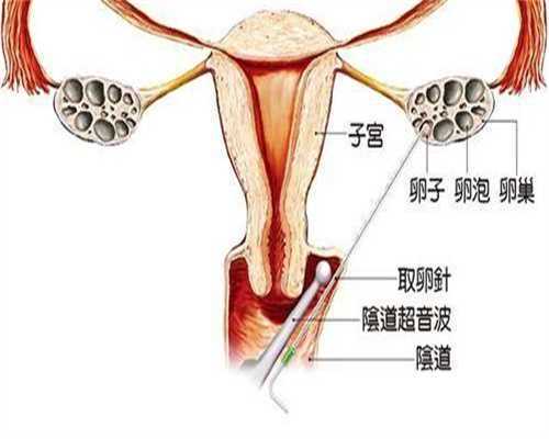 残角子宫试管