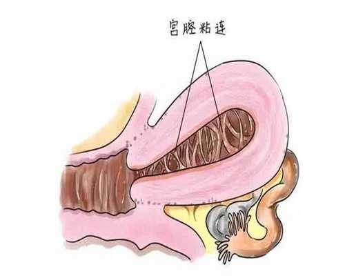 染色体罗氏易位试管